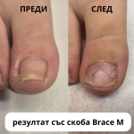Курс Brace M AArkada. Ефективна корекция на деформирани нокти Курс Brace M AArkada. Ефективна корекция на деформирани нокти
