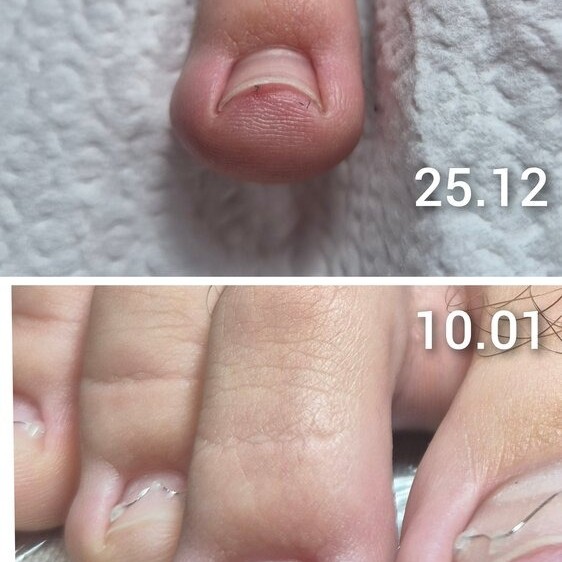 Arkada Sin Brace за корекция на враснали нокти Arkada Sin Brace за корекция на враснали нокти